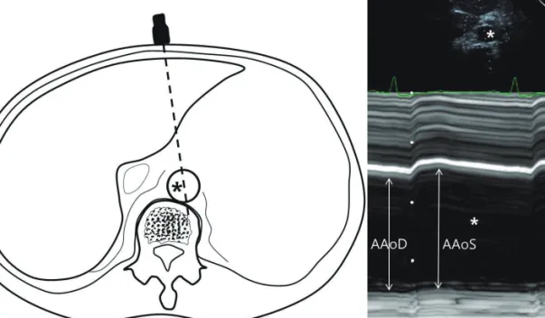 Fig. 1. Measurement of abdominal aortic strain. A sector probe was placed at the epigastrium targeting the spine, which typically shows a prominent an- an-terior wall excursion and a relatively fixed posan-terior wall