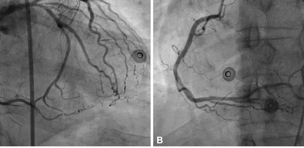 Fig. 1. A: left selective coronary angiogram shows no significant obstructive disease of left coronary artery and retrograde filling of the right coronary ar- ar-tery (RCA)