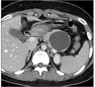 Fig.  1.  Preoperative  image  in  case  number  2.  About  large  6 cm-sized  pancreatic  cyst  was  noted  in  the  body  of  the  pancreas of  a  24-year-old  patient