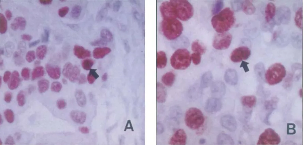 Fig. 1. Immunohistochemical staining  for ER and PR in human breast ductal  carcinoma(x 400)