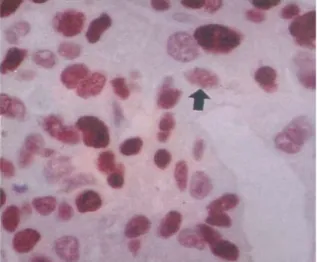 Fig. 2. Immunohistochemical staining for Ki-67 antigen in human breast ductal carcinoma(x 400)