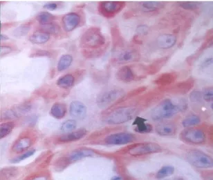 Fig. 5. Immunohistochemical staining for Bcl-2 in human breast ductal carcinoma(x 400)