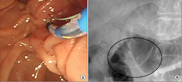 Fig.  2.  (A)  Preoperative  plastic  stent  was  inserted  to  pancreatic  duct  for  guiding  wedge  resection  or  enucleation  of  pancreatic tumor