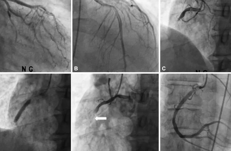 Fig. 1. Findings of coronary angiography and primary percutaneous coronary intervention