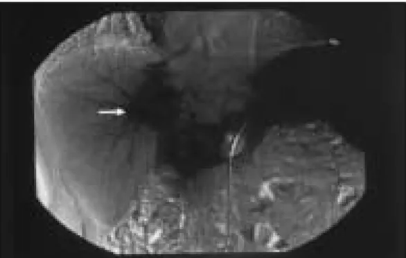 Fig 2. Hepatic angiogram shows a round, central located mass with high vascularity