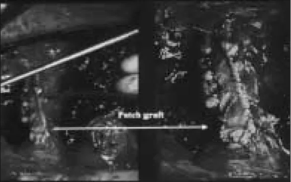 Fig 5. Intraoperative  photo  of  saphenous  vein patch graft