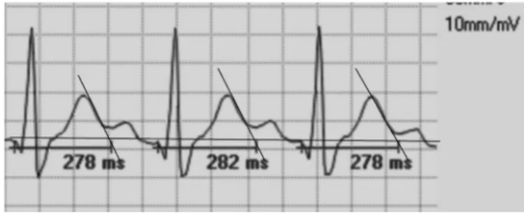 Fig. 1. Illustrates the representative example of exercise raw QT measure- measure-ment at 50 mm/s paper speed.