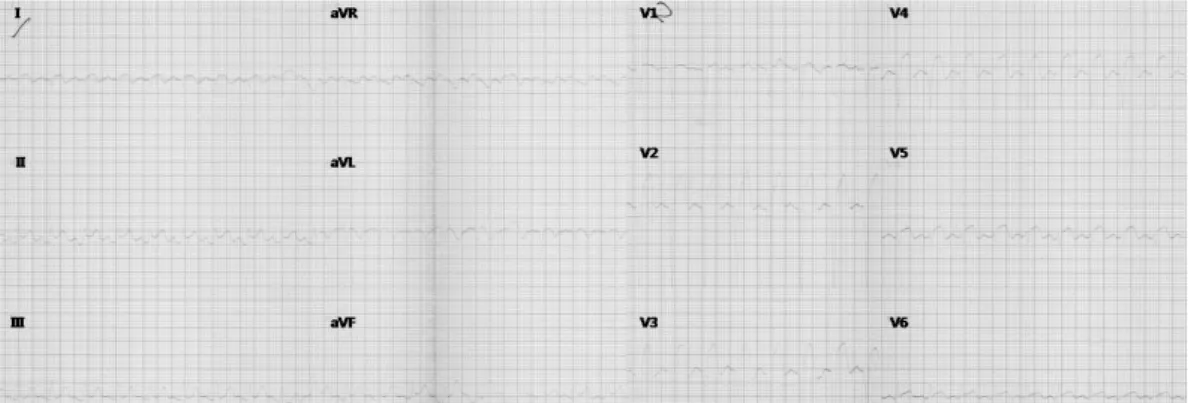 Fig. 1. ECG on February 21, 2000. The ECG shows ST-segment elevation in the inferior leads (II and aVF) and the anterior (V 2-4) leads