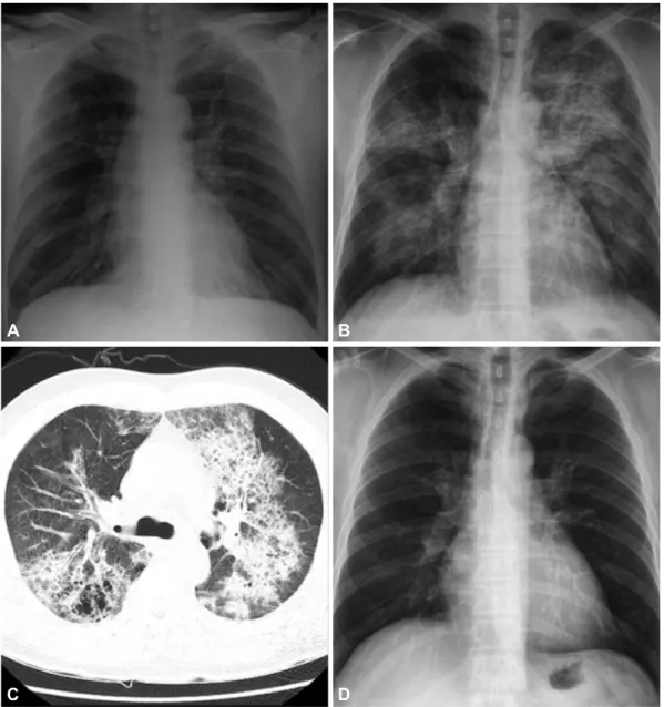 Fig. 1. A: the initial chest X-ray study shows no active lung lesion. B: the follow-up chest X-ray study showed bilateral alveolar and interstitial infiltration