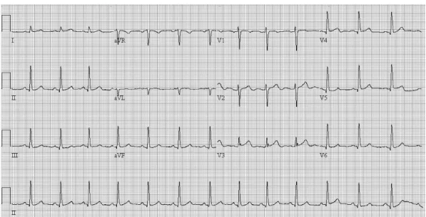 Fig. 2. Initial electrocardiography (ECG). ECG finding does not reveal any evidence of apical aneurysm.