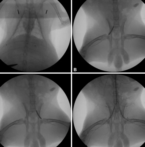 Fig. 4. Stent implantation and angiograms. Once the introducer sheath was inserted, heparin was injected intra-arterially through the introducer sheath  to prevent thrombus formation