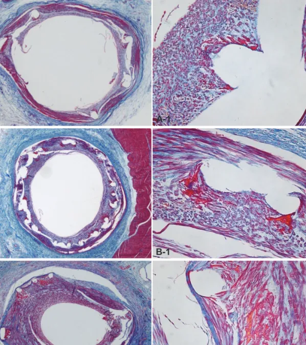 Fig. 2. The Carstair fibrin stain of the low-power fields (magnitude, ×20, ×200) of fibrin infiltration in BES implanted (A and A-1), ZES implanted (B and  B-1), and EES implanted (C and C-1)