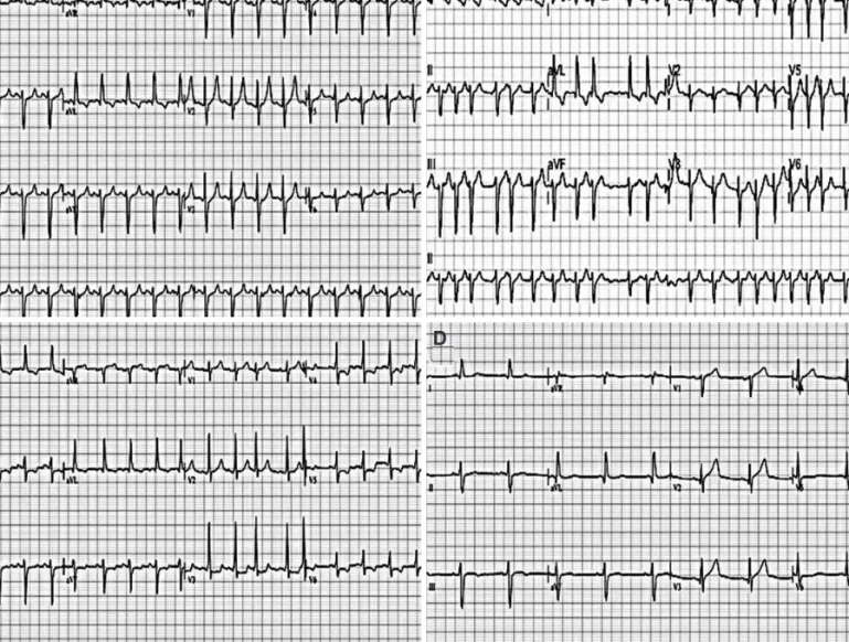 Fig. 1. Serial electrocardiograms of the patient. A: electrocardiogram (ECG) at initial presentation