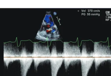 Fig. 2. Transthoracic echocardiography with continuous wave Doppler  study revealed significant left ventricular outflow tract obstructions with  pressure gradients of 55 mm Hg.
