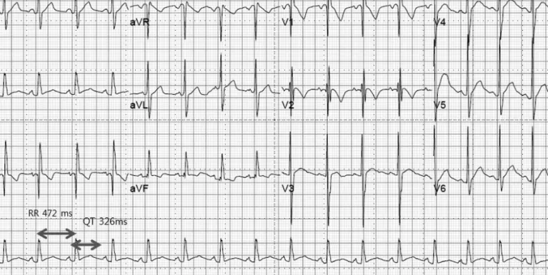 Fig. 2. Change in QTc over time. The average pre-operative QTc was 413.6± 