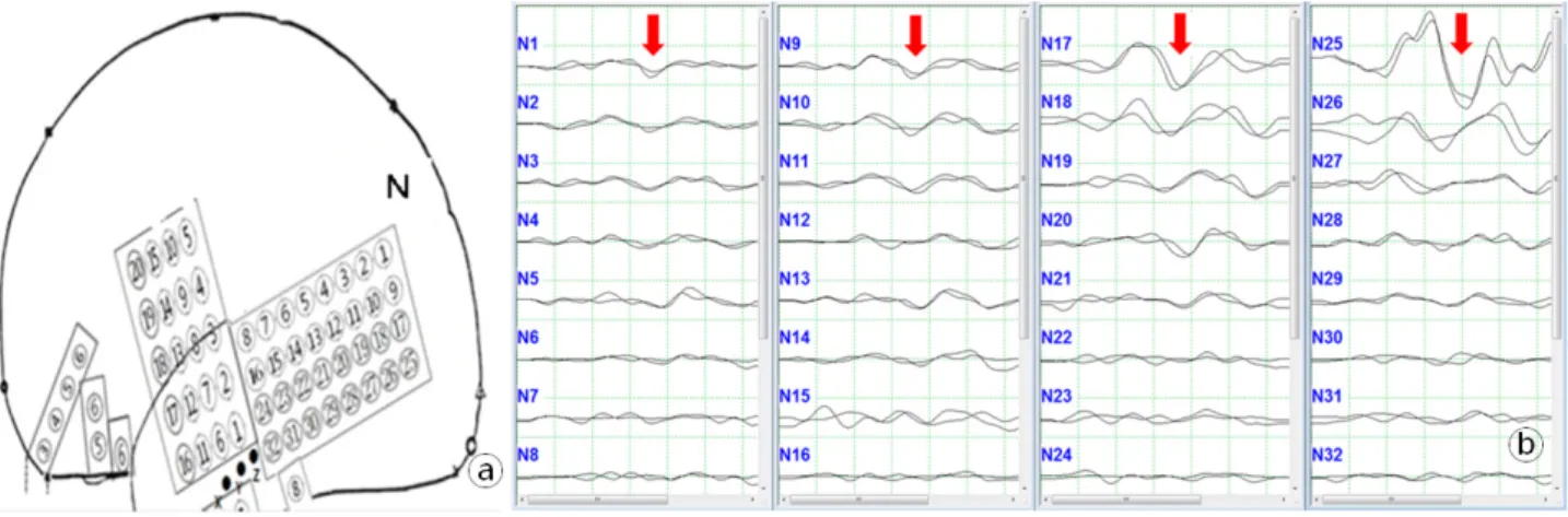 Figure  5.  Visual  evoked  potentials  measured  at  the  near  visual  cortex  ⓐ.  The  amplitude  of  the  waveform  gradually  increases  from  N1  to  N25  ⓑ.