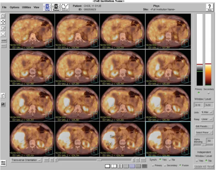 Fig. 2. 18FDG-PET/CT showed increasing metabolism of the right lobe (Sarcoma) and no FDG uptake (HCC).