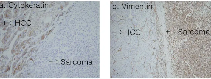 Fig. 3. Immunohistochemical staining: (a) HCC component stained specifically to cytokeratin; (b) Sarcoma component stained specifically  to vimentin.