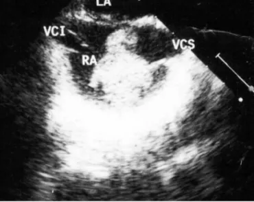 Fig. 2. Intraoperative view of the thrombus as shown in Fig. 1.