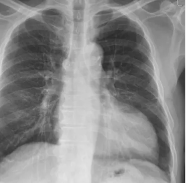 Fig. 2. Diagnostic coronary angiography. Coronary angiogram shows geographically circumferential phasic diastolic external compression of the obtuse  marginal branches of the left circumflex artery (white arrows), right ventricular branches and the posteri
