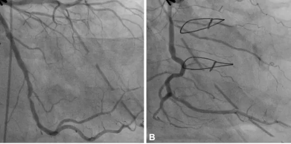 Fig. 5. A follow-up coronary angiography. Coronary angiogram show no features of the previous dynamic occlusion of the coronary arteries which were  shown in Fig