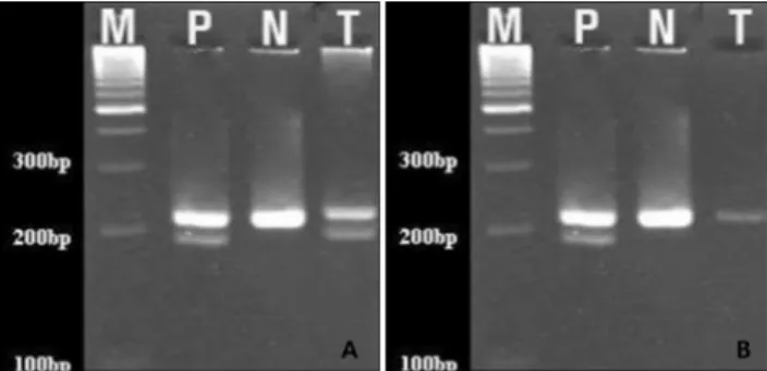 Fig.  3.  A  representative  results  showing  the  detection  of  B-type  Raf  kinase  BRAF V600E   mutation  in  fine–needle  aspirates  by   polymer-ase  chain  reaction-restriction  fragment  length  polymorphism  (PCR-RFLP)