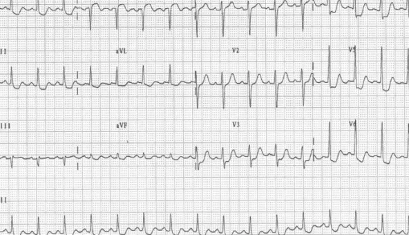 Fig. 2. Coronary angiography showing diffuse left main coronary artery vasospasm (A) and resolution of the spasm after administration of intracoronary  nitrates (B).