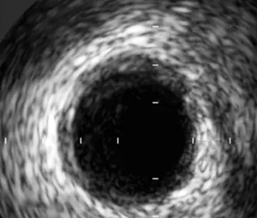 Fig. 5. Follow up electrocardiogram (ECG) showing a normalized ST segment deviation after intracoronary nitrate.