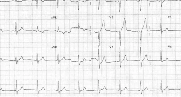 Fig. 2. One year before this event, coronary angiography revealed a diffuse, eccentric luminal narrowing up to 90% (A) and percutaneous coronary inter- inter-vention with Cypher Select 3.5×28 (Johnson &amp; Johnson-Cordis, Miami, FL, USA) was performed due