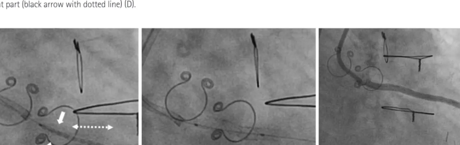 Fig. 3. A sirolimus-eluting stent was deployed connect the distal part of the fractured stent (two white thick arrows) with the proximal part of the residual  stent (arrow with dotted line) to prevent systemic stent embolization (A)