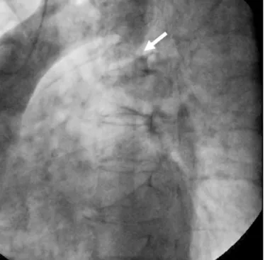 Fig. 3. Postoperative three-dimensional computed tomography revealed  an extra-anatomic bypass graft from the ascending to the descending  aor-ta (arrow).
