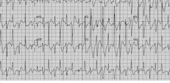 Fig. 2. Baseline electrocardiogram shows a normal sinus rhythm with a normal QT interval.