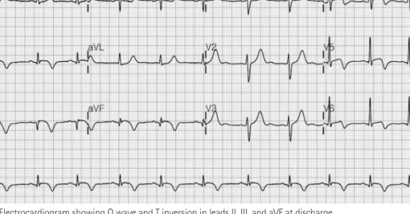 Fig. 3. Electrocardiogram showing Q wave and T inversion in leads II, III, and aVF at discharge.