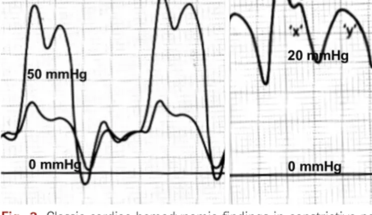 Fig. 3. Classic cardiac hemodynamic findings in constrictive pericarditis. 