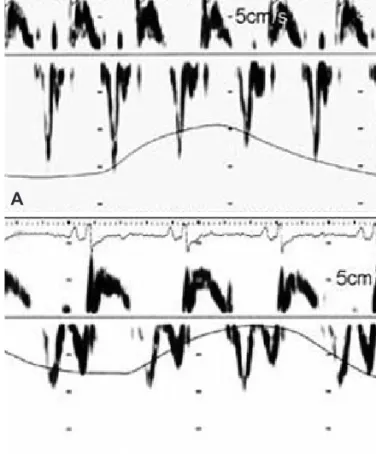 Fig. 9. Mitral annulus velocity in a patient with constrictive pericarditis be- be-fore (A) and after (B) pericardiectomy