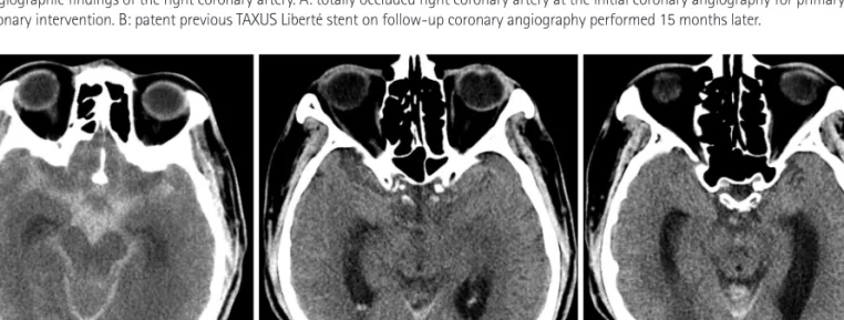 Fig. 2. Initial brain CT shows. A: diffuse acute subarachnoid hemorrhage (maximum 65 HU) in the basal, interpeduncular, ambient and both lateral cisterns