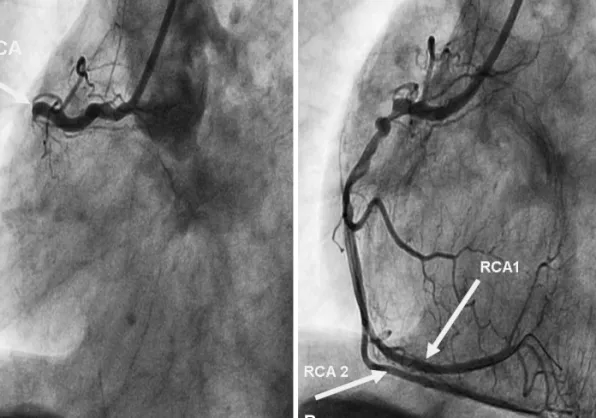 Fig. 1. Coronary angiography LAO view. A: totally occluded proximal RCA before percutaneous coronary intervention