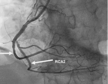 Fig. 3. Left anterior oblique view of coronary angiography after implanta- implanta-tion of a bare metal stent.