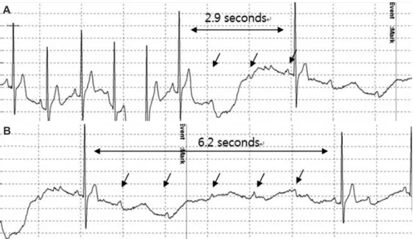 Fig. 1. First head-up tilt test. The patient was given a cold beverage at 3 minutes during the first passive tilt test