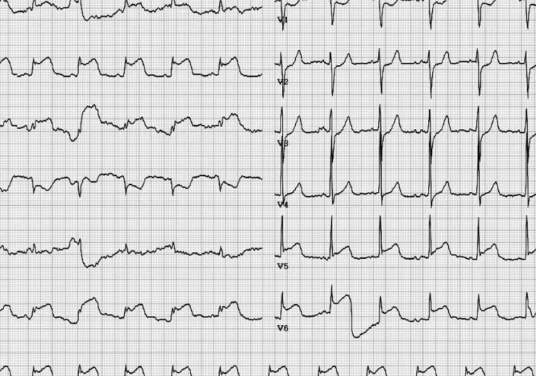 Fig. 1. Twelve-lead surface electrocardiogram showing extensive ST elevation (II, III, aVF) and ST depression (V 1,2 ).