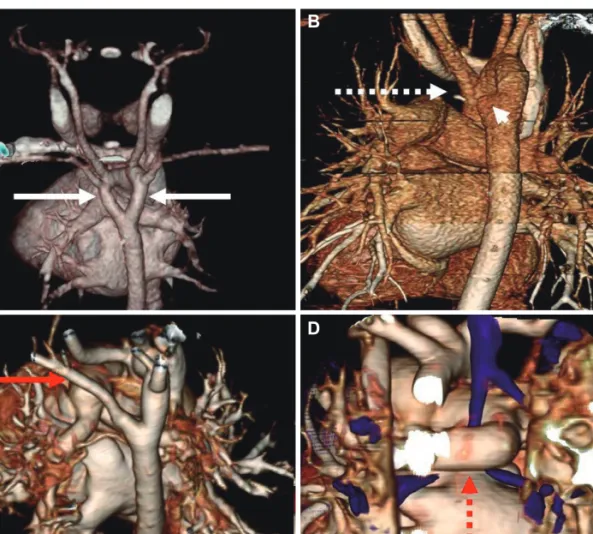 Fig. 1. The three-dimensional structures of diverse types of vascular rings, reconstructed from cardiac computed tomography