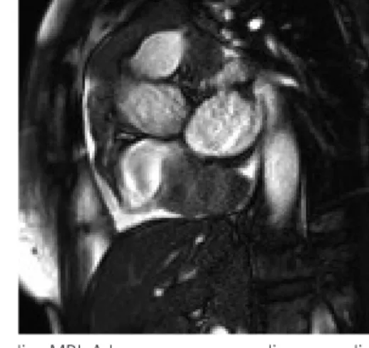 Fig. 3. Cardiac MRI. A large mass surrounding ascending aorta spread into  transverse sinus and around pulmonary trunk and right pulmonary artery.
