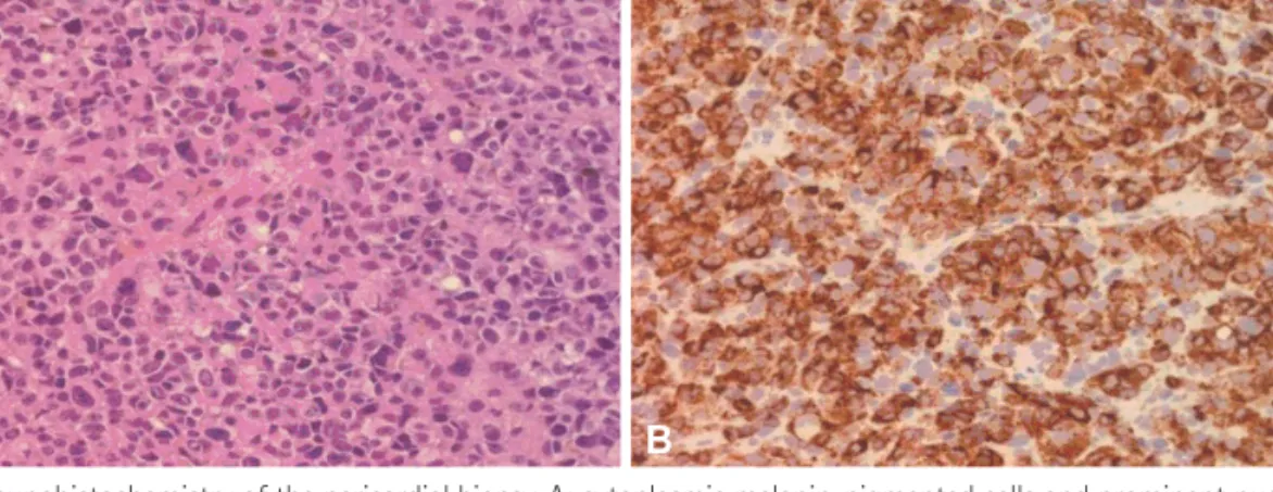 Fig. 4. Pathology and immunohistochemistry of the pericardial biopsy. A: cytoplasmic melanin-pigmented cells and prominent nucleoli were found (×200)