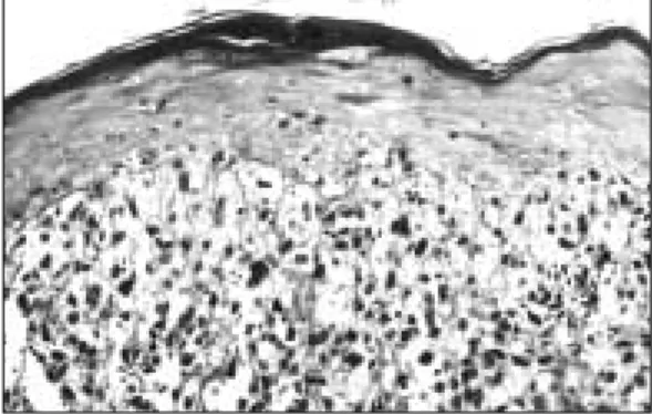 Fig. 4 Skin involvement of tumor. Pleomorphic atypical cells are diffusely scattered in dermis