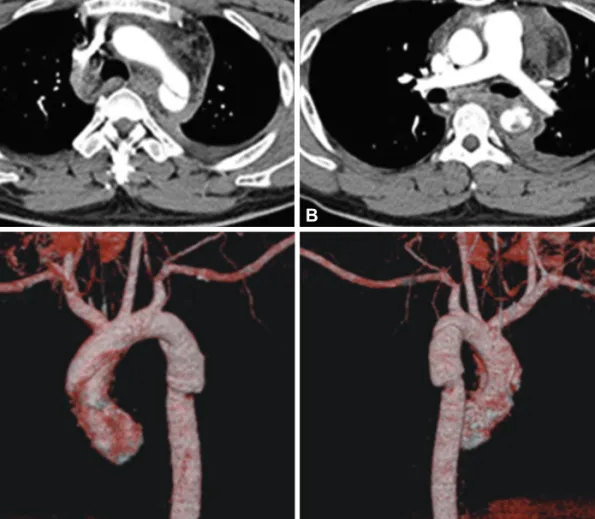 Fig. 1. Chest computed tomography angiogram shows traumatic aortic dissection in proximal descending thoracic aorta/distal aortic arch around aortic  isthmus with left pleural effusion
