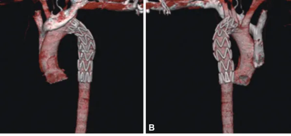 Fig. 2. Follow-up chest computed tomography angiogram shows vascular stent graft insertion state from distal aortic arch to proximal descending tho- tho-racic aorta and resolved state of previous traumatic aortic dissection