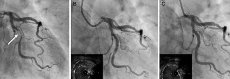 Fig. 1. Coronary angiogram for pecutaneous coronary intervention for critical stenosis of left