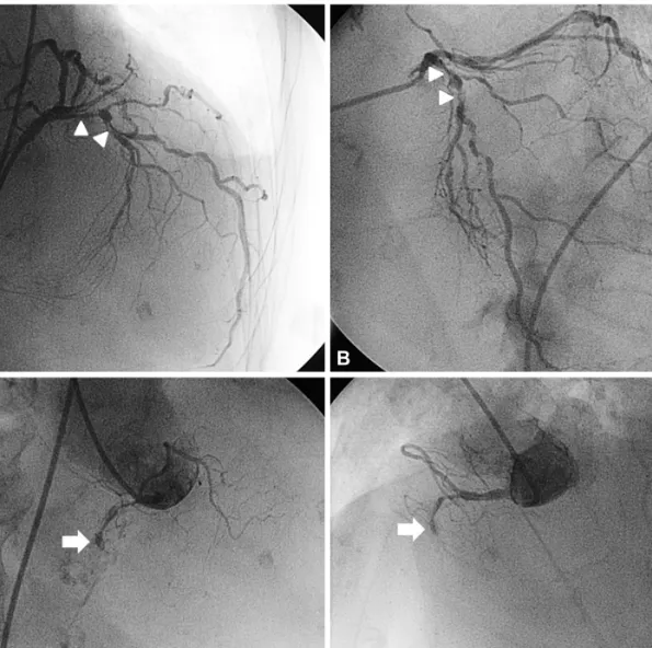 Fig. 2. Coronary angiography shows a significant stenosis of the proximal to mid left anterior descending artery (arrowheads) (A and B) and total throm- throm-botic occlusion of the proximal right coronary artery (arrow) (C and D).