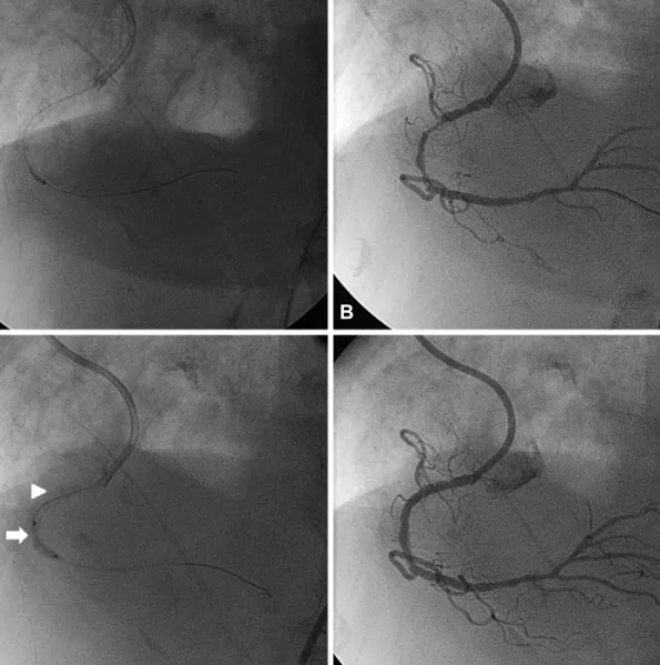 Fig. 3. Balloon angioplasty using a 1.5×13 mm balloon was performed in the proximal and mid RCA (A and B)