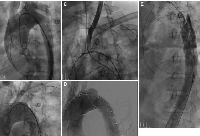Fig. 2. The overall procedure of the patient. A: the aortogram before stent graft deployment; the proximal entry tear was distal to the LSCA